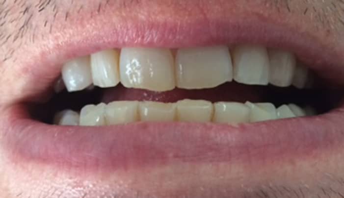 Before - Smilemakerdentalcare