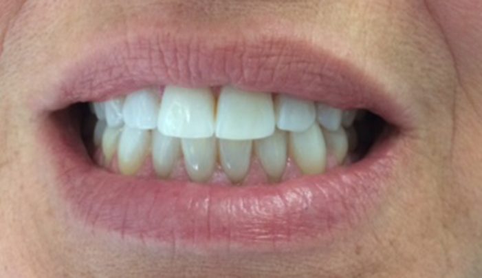 After - Smilemakerdentalcare