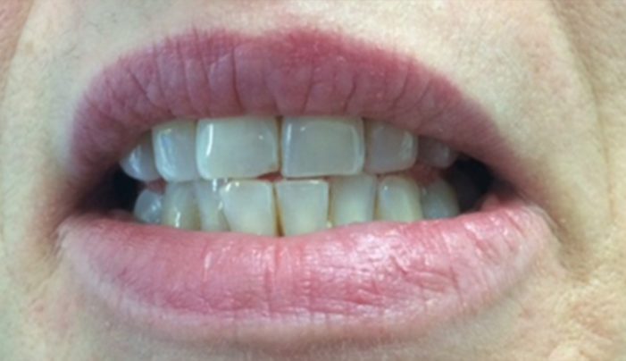 Before - Smilemakerdentalcare