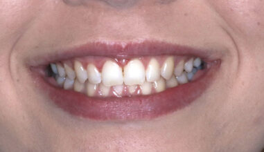 After - Smilemakerdentalcare