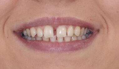 Before - Smilemakerdentalcare