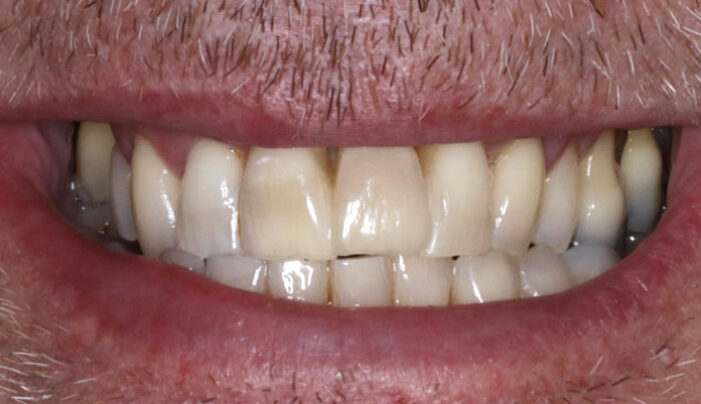After - Smilemakerdentalcare