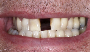 Before - Smilemakerdentalcare