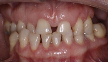 Before - Smilemakerdentalcare
