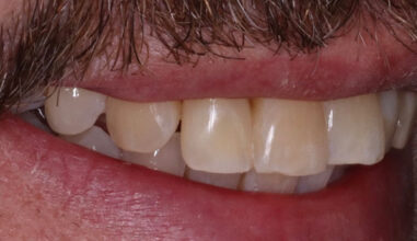 After - Smilemakerdentalcare