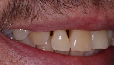 Before - Smilemakerdentalcare