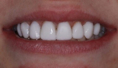 After - Smilemakerdentalcare