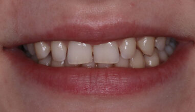Before - Smilemakerdentalcare
