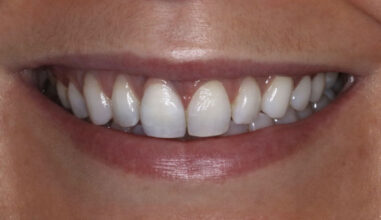 After - Smilemakerdentalcare