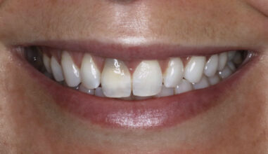 Before - Smilemakerdentalcare