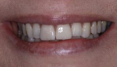 After - Smilemakerdentalcare
