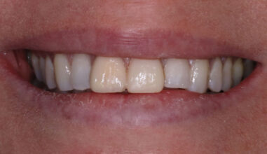 Before - Smilemakerdentalcare