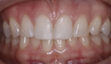 After - Smilemakerdentalcare