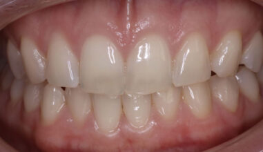 Before - Smilemakerdentalcare