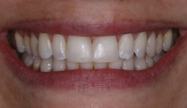 After - Smilemakerdentalcare
