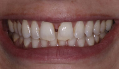 Before - Smilemakerdentalcare