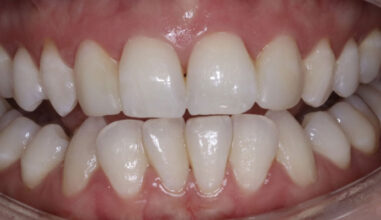 After - Smilemakerdentalcare
