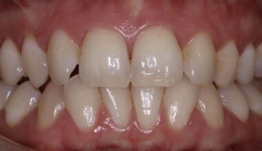 Before - Smilemakerdentalcare