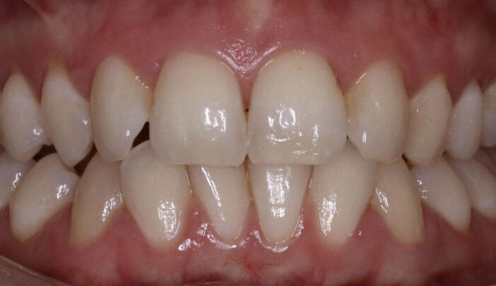 Before - Smilemakerdentalcare